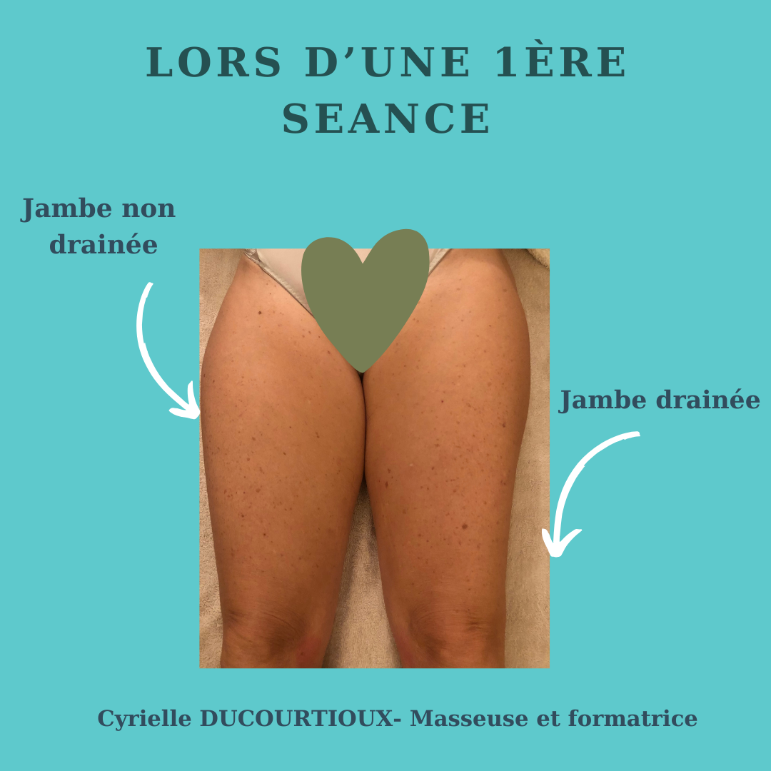 Effets du drainage  lymphatique brésilien  Marcy l'etoile avant apres